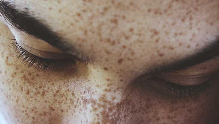 how to take care of freckles effectively