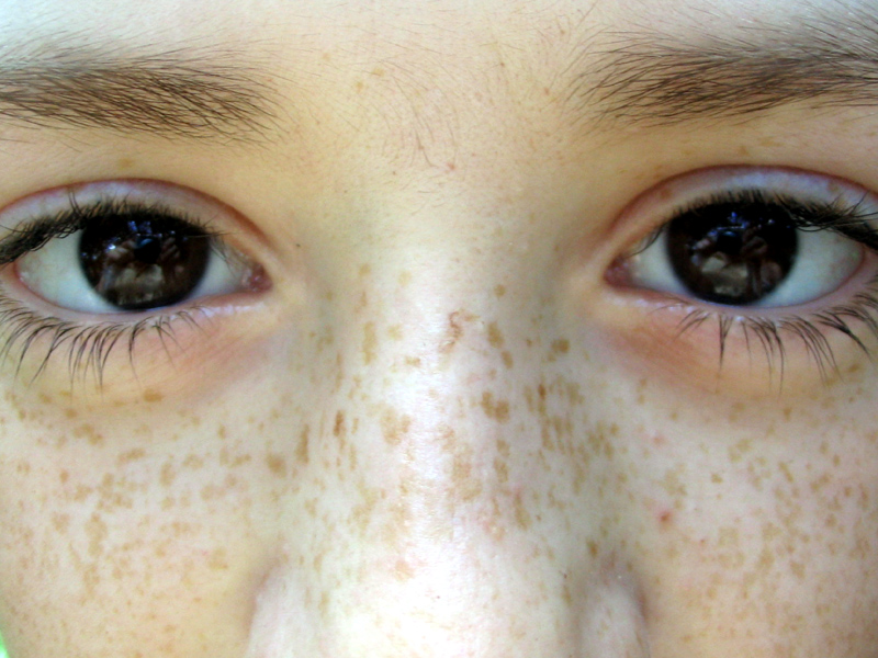 how to take care of freckles know the cause